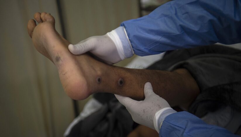 Mpox. Variola maimuței. Sursa foto: Profimedia Images