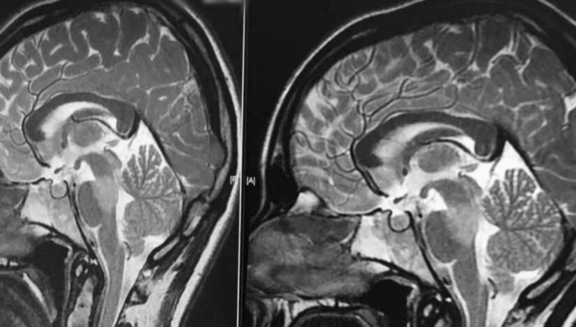 Un nou tip de RMN mai puternic. Cercetătorii speră să înţeleagă mai bine tulburările de neurodezvoltare şi bolile cerebrale la copii