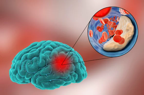Peste 65.000 de pacienţi cu AVC au fost trataţi în perioada 1 ianuarie 2024 – 30 septembrie 2025. Cel mai tânăr, 21 de ani
