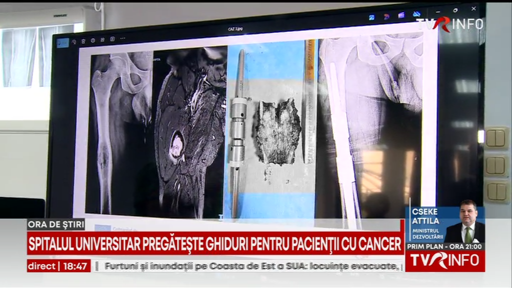 Primul program integrat din România de formare în tratarea cancerelor musculo-scheletale, lansat de experţii de la Spitalul Universitar. Sunt pregătite ghiduri pentru pacienţi