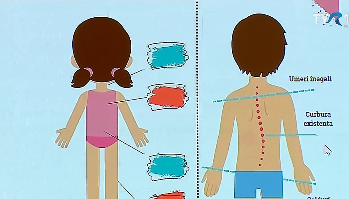 Probleme cu spatele la copii, de la vârste tot mai fragede. Totul pleacă de la postura greşită la telefon şi în bancă